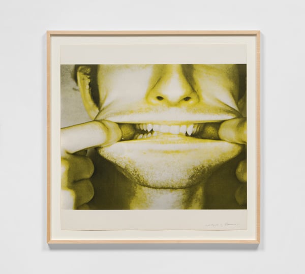 A photograph shows a close-up of a man's mouth with fingers pulling his lips back to reveal teeth